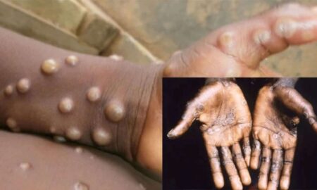Monkeypox in Abia State